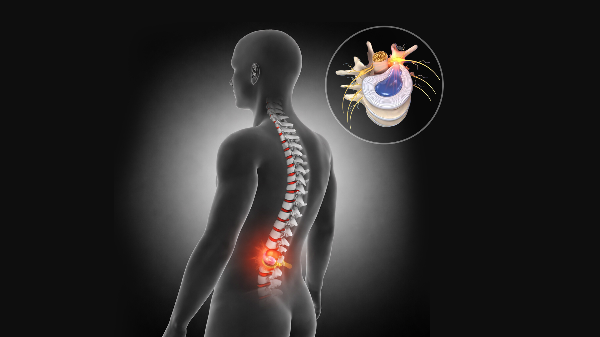 Ce este hernia de disc?